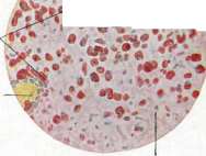 Papilledema: figure 2 from the 1928–1936 encyclopedia article