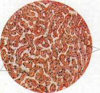 Papilledema: figure 4 from the 1928–1936 encyclopedia article