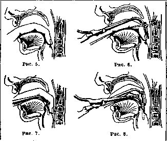 Intubation: figure 6 from the 1928–1936 encyclopedia article