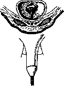 Lithotripsy: figure 7 from the 1928–1936 encyclopedia article