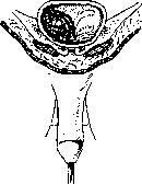 Lithotripsy: figure 9 from the 1928–1936 encyclopedia article
