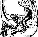 Lithotomy: figure 3 from the 1928–1936 encyclopedia article