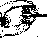 Canthoplasty: figure 1 from the 1928–1936 encyclopedia article