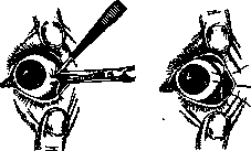 Canthoplasty: figure 2 from the 1928–1936 encyclopedia article