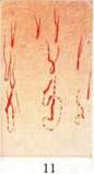 Capillaroscopy: figure 4 from the 1928–1936 encyclopedia article
