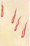 Capillaroscopy: figure 3 from the 1928–1936 encyclopedia article