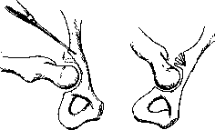König Operation: figure 1 from the 1928–1936 encyclopedia article