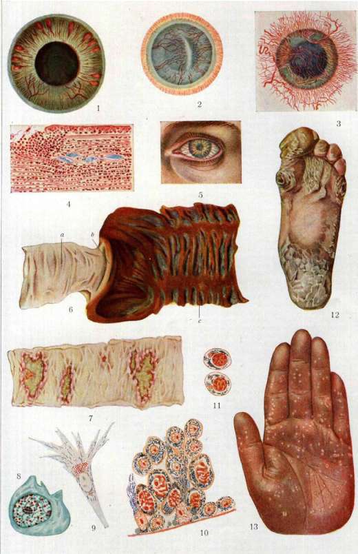 Keratitis: figure 4 from the 1928–1936 encyclopedia article