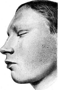Keratoses: figure 2 from the 1928–1936 encyclopedia article