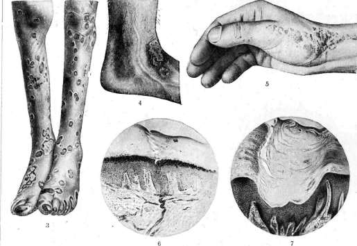Keratoses: figure 4 from the 1928–1936 encyclopedia article