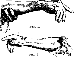 Kozhevnikov's Epilepsy: figure 3 from the 1928–1936 encyclopedia article