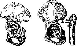 Pertussis: figure 13 from the 1928–1936 encyclopedia article
