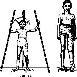 Pertussis: figure 22 from the 1928–1936 encyclopedia article