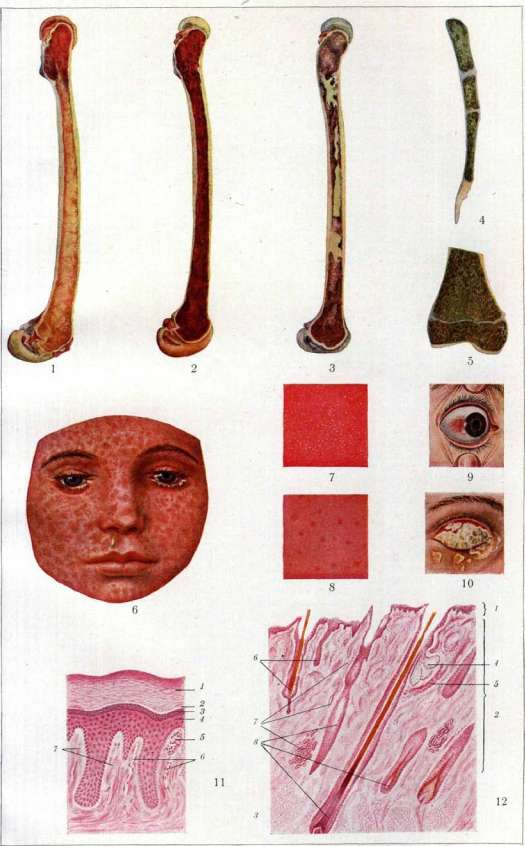 Conjunctivitis: figure 1 from the 1928–1936 encyclopedia article