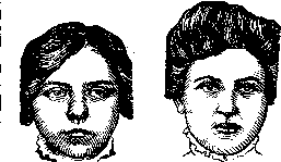 Strabismus: figure 3 from the 1928–1936 encyclopedia article