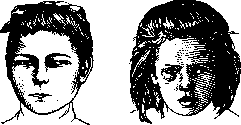 Strabismus: figure 2 from the 1928–1936 encyclopedia article