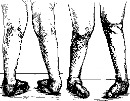 Clubfoot: figure 3 from the 1928–1936 encyclopedia article