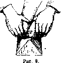 Clubfoot: figure 5 from the 1928–1936 encyclopedia article