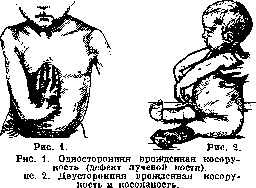Clubhand: figure 1 from the 1928–1936 encyclopedia article
