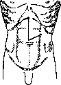Laparotomy: figure 8 from the 1928–1936 encyclopedia article