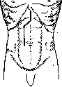 Laparotomy: figure 9 from the 1928–1936 encyclopedia article