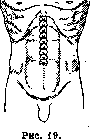 Laparotomy: figure 14 from the 1928–1936 encyclopedia article