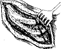 Laparotomy: figure 12 from the 1928–1936 encyclopedia article