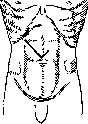 Laparotomy: figure 10 from the 1928–1936 encyclopedia article