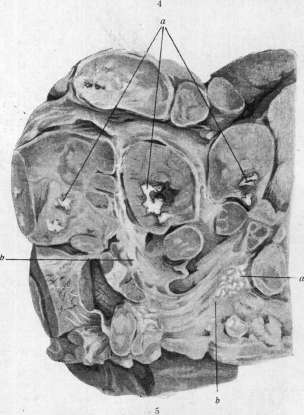 Lymphogranulomatosis: figure 4 from the 1928–1936 encyclopedia article
