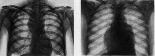 Lymphogranulomatosis: figure 6 from the 1928–1936 encyclopedia article