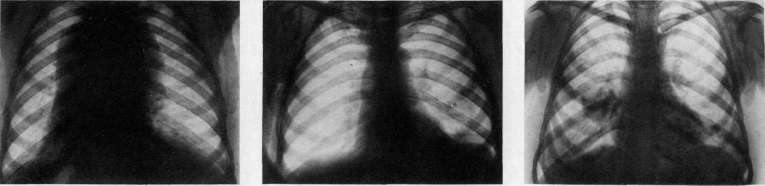 Lymphogranulomatosis: figure 7 from the 1928–1936 encyclopedia article