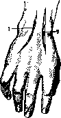 Radiocarpal Joint: figure 11 from the 1928–1936 encyclopedia article