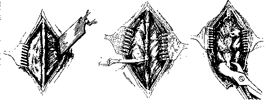 Laminectomy: figure 1 from the 1928–1936 encyclopedia article