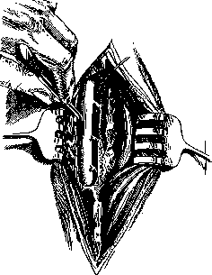 Laminectomy: figure 4 from the 1928–1936 encyclopedia article