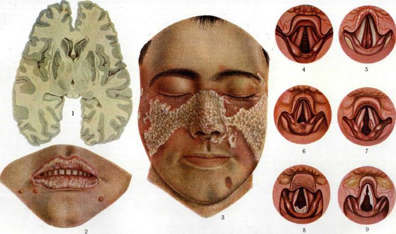 Laryngitis: figure 1 from the 1928–1936 encyclopedia article