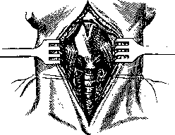 Laryngofissure: figure 1 from the 1928–1936 encyclopedia article