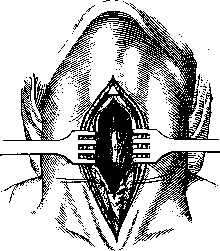 Laryngofissure: figure 2 from the 1928–1936 encyclopedia article