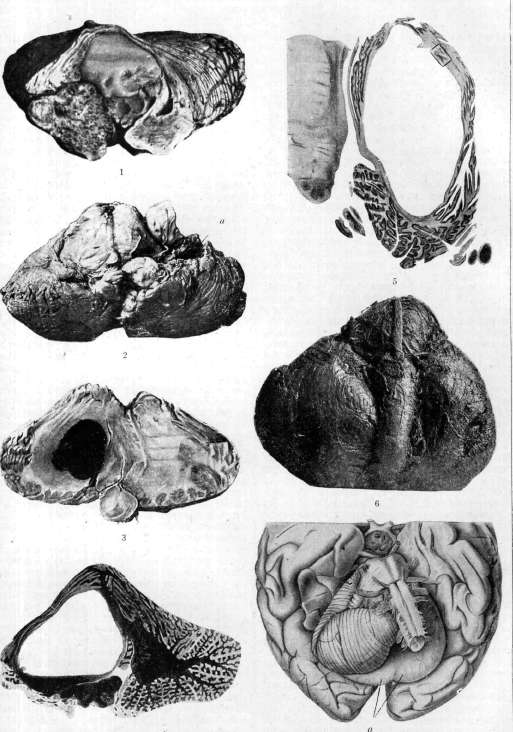 Cerebellopontine Angle: figure 29 from the 1928–1936 encyclopedia article