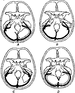 Cerebellopontine Angle: figure 3 from the 1928–1936 encyclopedia article
