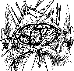 Cerebellopontine Angle: figure 4 from the 1928–1936 encyclopedia article