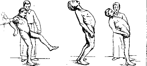 Cerebellopontine Angle: figure 26 from the 1928–1936 encyclopedia article