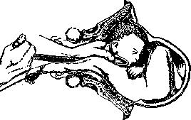 Embryotomy: figure 1 from the 1928–1936 encyclopedia article
