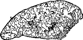 Emphysema: figure 1 from the 1928–1936 encyclopedia article