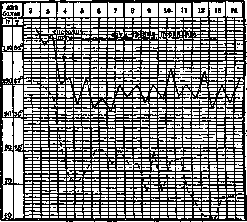 Endocarditis: figure 6 from the 1928–1936 encyclopedia article
