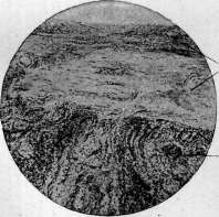Acute Rheumatism: figure 8 from the 1928–1936 encyclopedia article