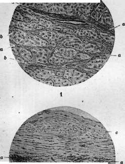 Acute Rheumatism: figure 3 from the 1928–1936 encyclopedia article