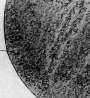 Acute Rheumatism: figure 6 from the 1928–1936 encyclopedia article
