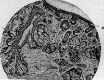 Acute Rheumatism: figure 9 from the 1928–1936 encyclopedia article