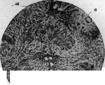 Acute Rheumatism: figure 4 from the 1928–1936 encyclopedia article