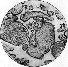 Syphilis: figure 10 from the 1928–1936 encyclopedia article